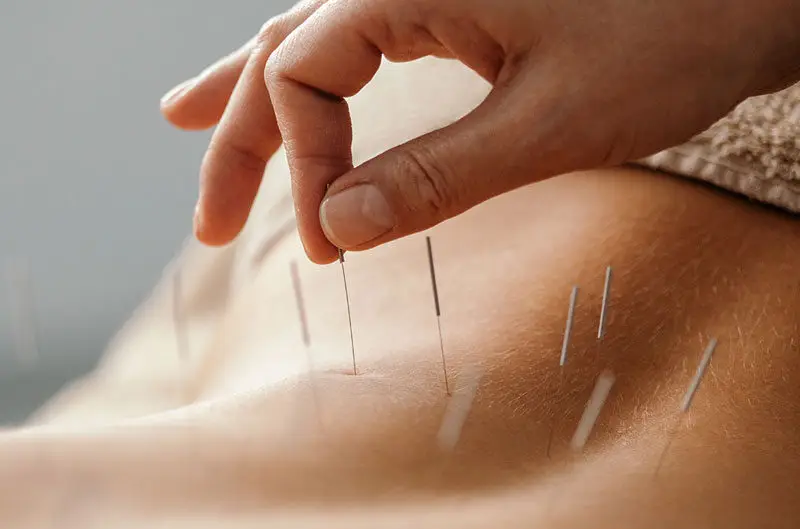 Acupunture treatment